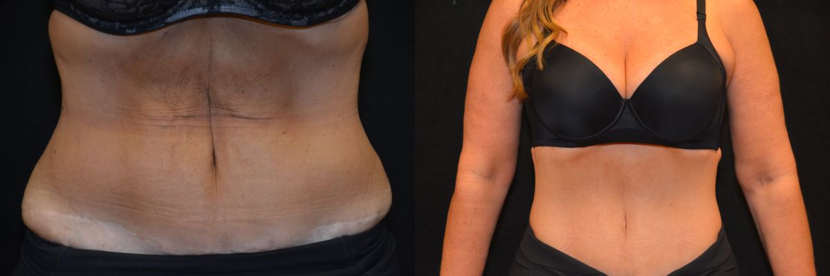 Tummy Tuck Before & After