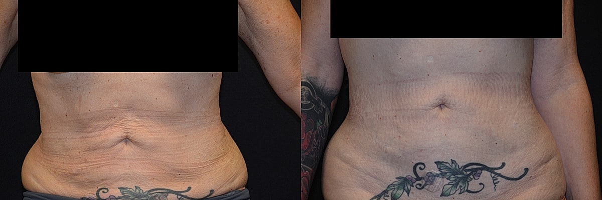 Tummy Tuck Before & After