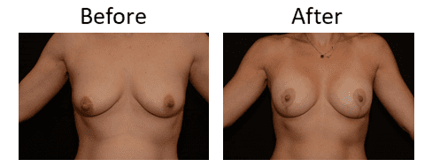 Breast Lift Before & After