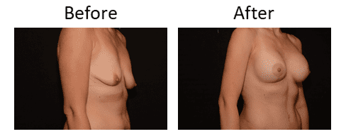 Breast Lift Before & After