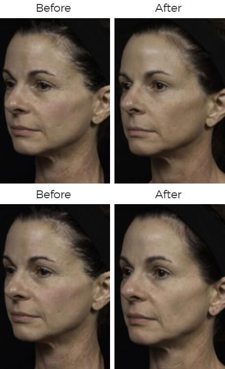 Thermage Before & After