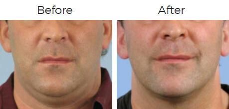 Thermage Before & After