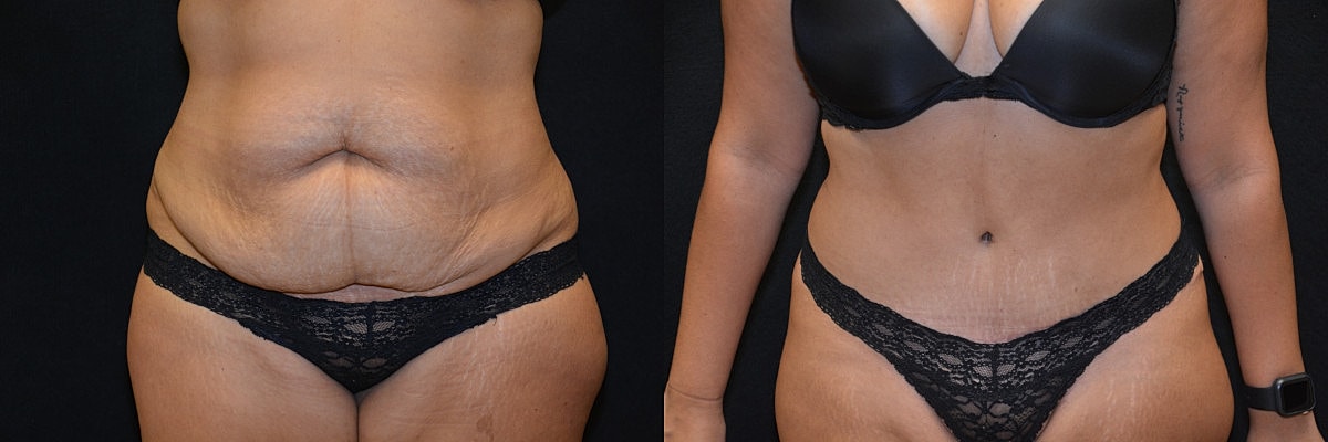 Abdominoplasty Before & After