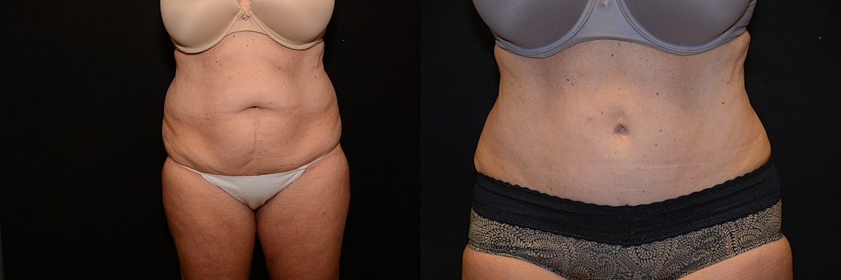 Abdominoplasty Before & After