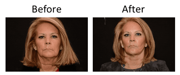 Facelift Before & After
