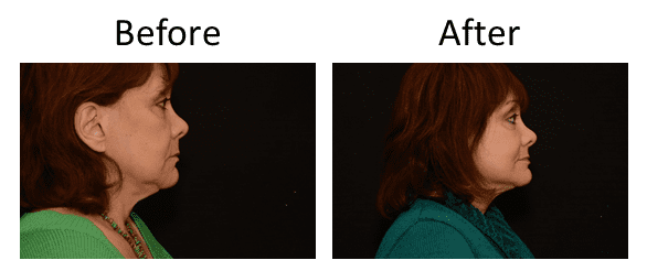 Facelift Before & After