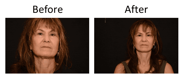 Facelift Before & After