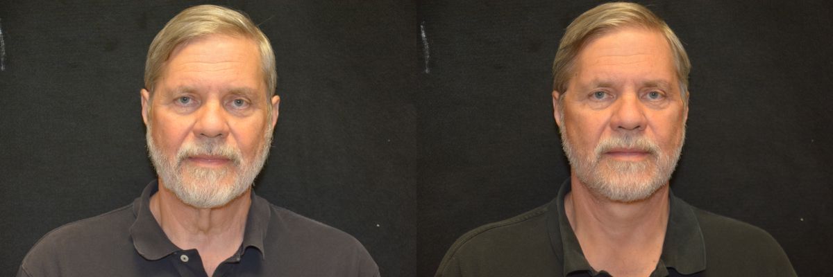 Facelift Before & After