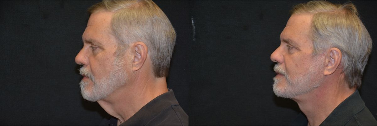 Facelift Before & After