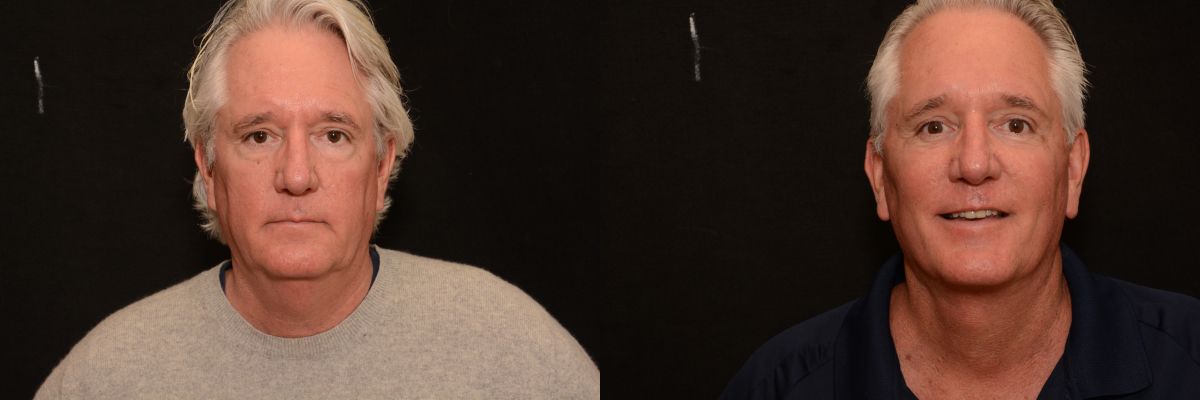 Facelift Before & After