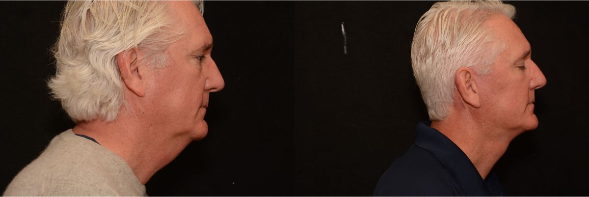 Facelift Before & After