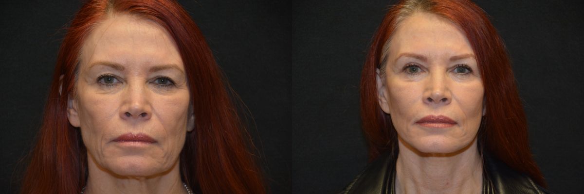 Facelift Before & After