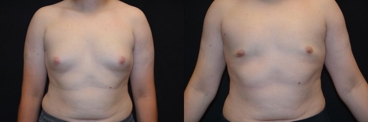 Gynecomastia Before & After