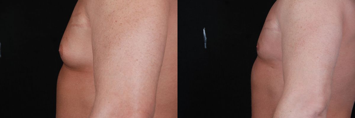 Gynecomastia Before & After