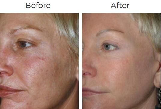 Fraxel Before & After