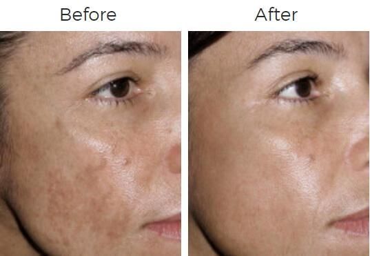 Fraxel Before & After