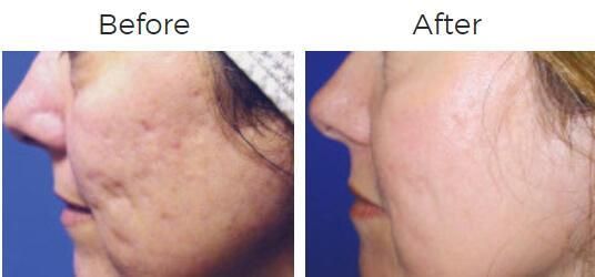 Fraxel Before & After