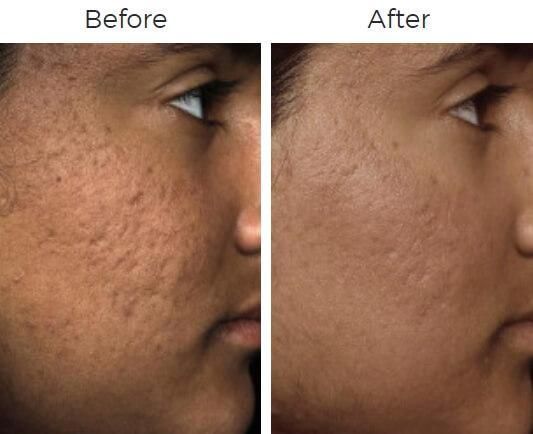 Fraxel Before & After