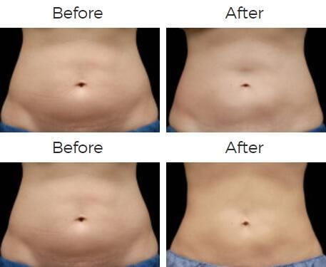 Coolsculpting Before & After