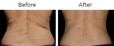 Coolsculpting Before & After