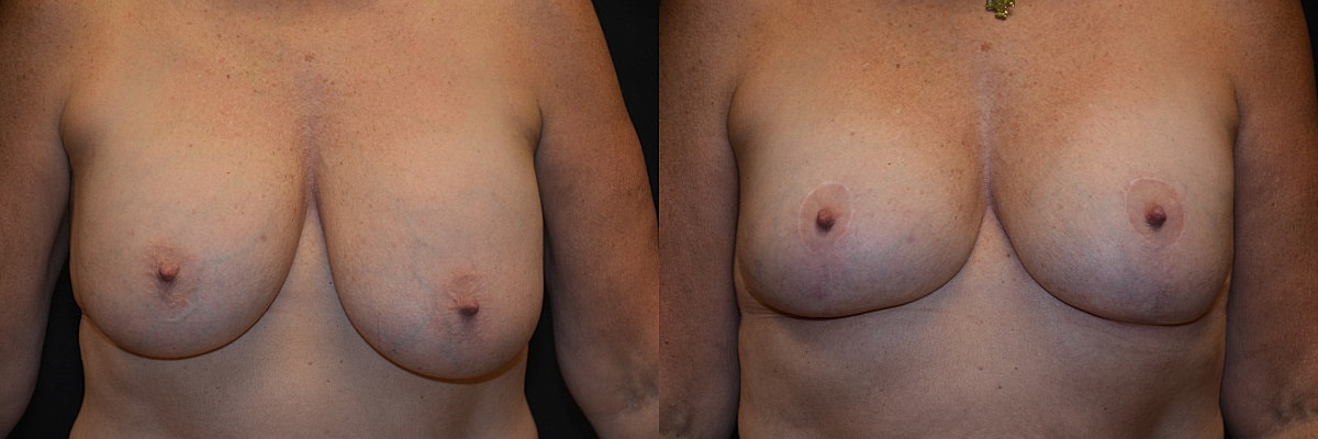 Breast Augmentation With Lift Before & After