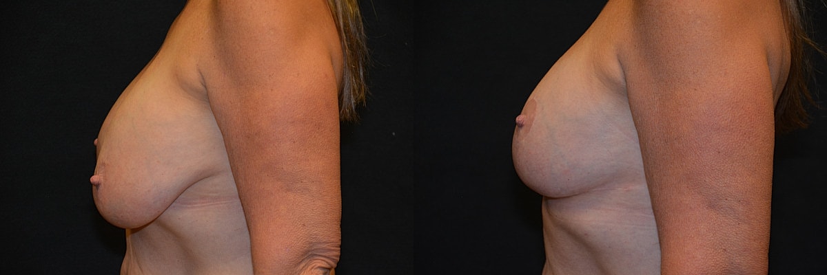 Breast Augmentation With Lift Before & After