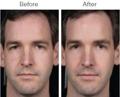 Clear Brilliant Before & After