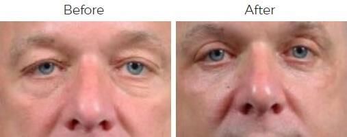 Blepharoplasty Before & After