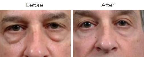 Blepharoplasty Before & After