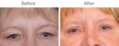Blepharoplasty Before & After