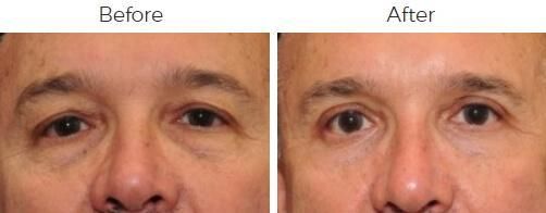 Blepharoplasty Before & After