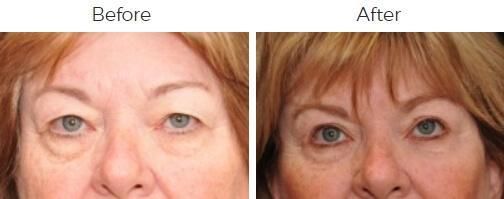 Blepharoplasty Before & After