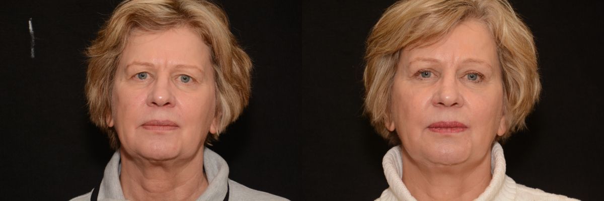 Blepharoplasty Before & After