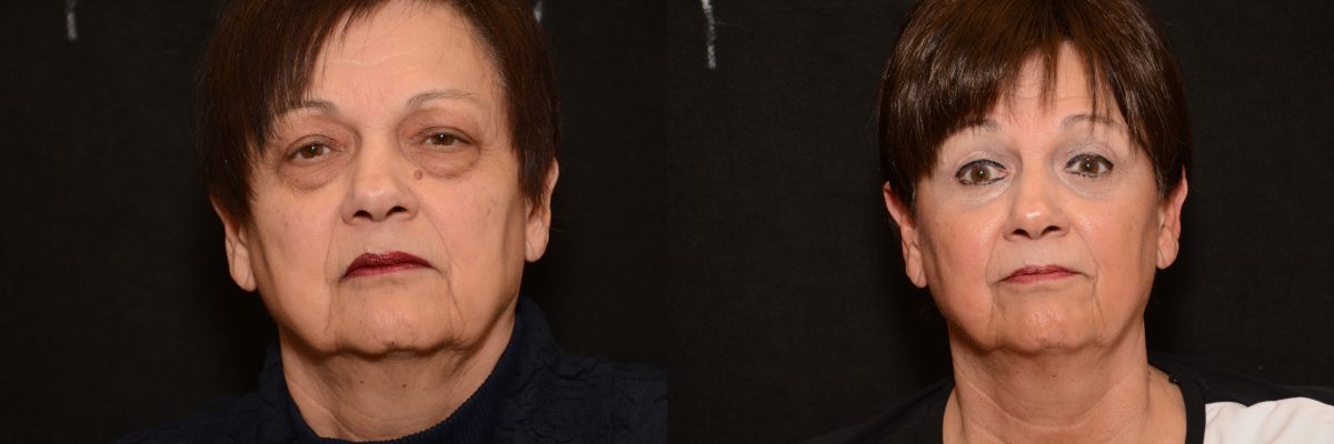 Blepharoplasty Before & After