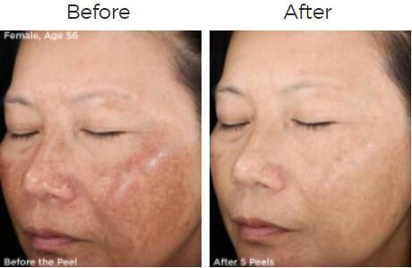 Rejuvenize Peel Before & After