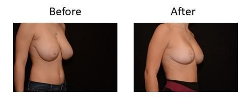 Breast Reduction Before & After