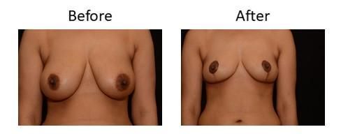 Breast Reduction Before & After